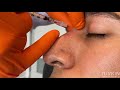 Non surgical nose job by dr rivkin