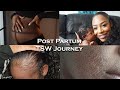 Post Partum And TSW | Red Skin Syndrome, Hair Loss, First Time Mum