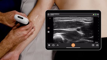 POCUS of the Radial Nerve in the Forearm