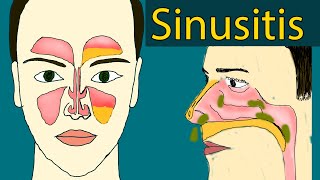 Sinusitis  Symptoms and treatment;  Sinus Infection, Chronic sinusitis