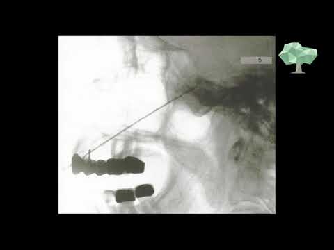 Herpes Zoster im Gesicht