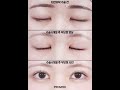 여러겹의 라인의 하나로 깔끔하게 ✨ 보정없는 쌍수 전후 비교 ! #자연유착