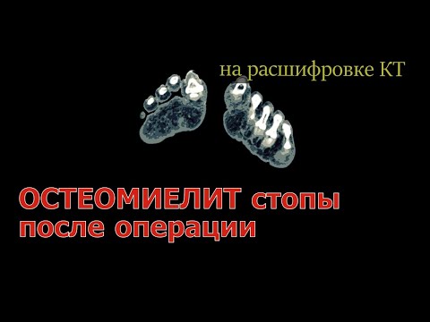 ОСТЕОМИЕЛИТ СТОПЫ после операции hallux valgus. Остеомиелит плюсневой кости на РАСШИФРОВКЕ КТ стопы.