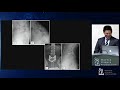 Evaluation and Treatment of High Grade Spondylolisthesis - Daniel G. Kang, M.D.