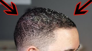 Giant HARDENED FLAKES Dandruff REMOVAL From Hair! Scalp TREATMENT Haircut Tutorial