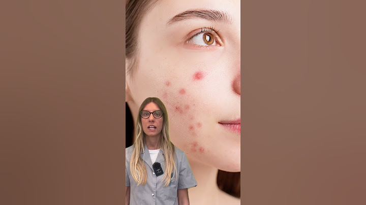 🤔 Conosci davvero le cause dell'acne? 👉 Ecco alcune di esse!