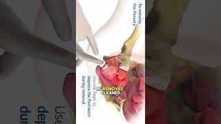 Pessary Ring for Prolapse 3D  Animation
