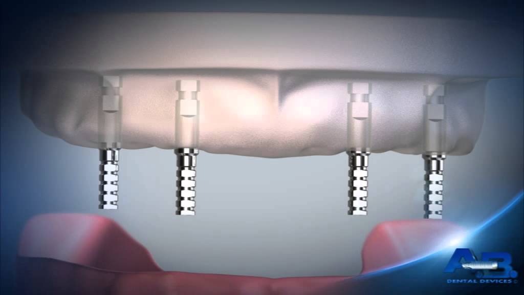 A B Implants Canada P14 Multi unit angular adaptor for screw retained