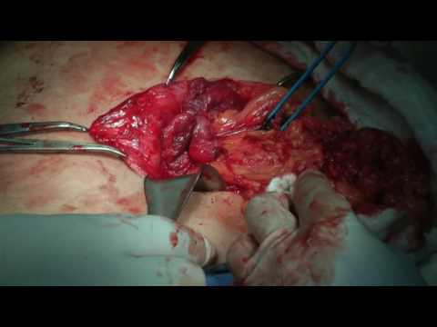 Vídeo: Hernia Umbilical: Síntomas, Tratamiento, Extirpación En Adultos, Cirugía