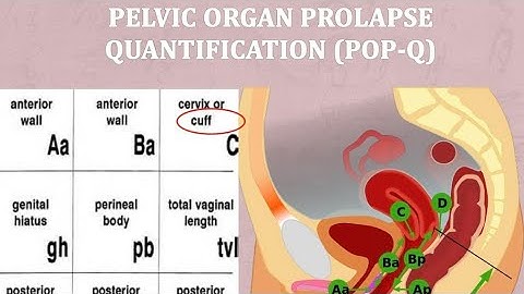 POP Q PELVIC ORGAN PROLAPSE QUANTIFICATION for MRCOG Part 3