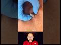 This Giant Blackhead Was Hiding for WEEKS 😳 #shorts