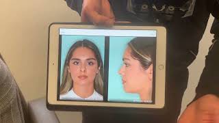 Tip refinement techniques in a Hispanic female   I   Anthony Bared, MD, FACS   I   Miami, FL