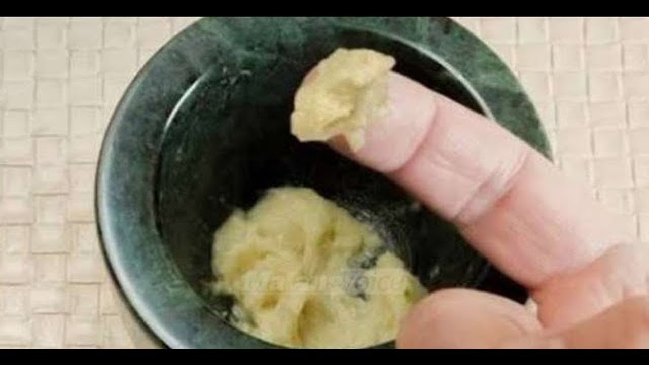 Cara Menghilangkan KUTIL KEMALUAN dengan bawang putih