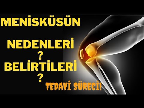 Menisküs yırtılmasının nedenleri Nelerdir.? Menisküs belirtisi ve Tedavi Süreci.? Sağlık Videoları.