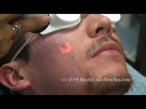 Active FX Laser Acne Scars Removal