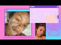 FIRST TIME MICRONEEDLING EXPERIENCE | POST TREATMENT AFFORDABLE AFTERCARE AND REACTION