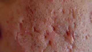 What Causes Acne Scars [DermTV.com Epi #563]