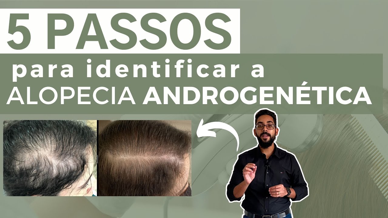 5 PASSOS PARA IDENTIFICAR A ALOPECIA ANDROGENÉTICA (AAG) | Dr. João Gabriel Fernandes