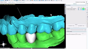 BSP 4.13: Crown for Titanium Base Abutment. AI Automatic Tooth Design. Design and Export Free!