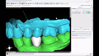 BSP 4.13: Crown for Titanium Base Abutment. AI Automatic Tooth Design. Design and Export Free! by BlueSky Bio 514 views 5 days ago 15 minutes