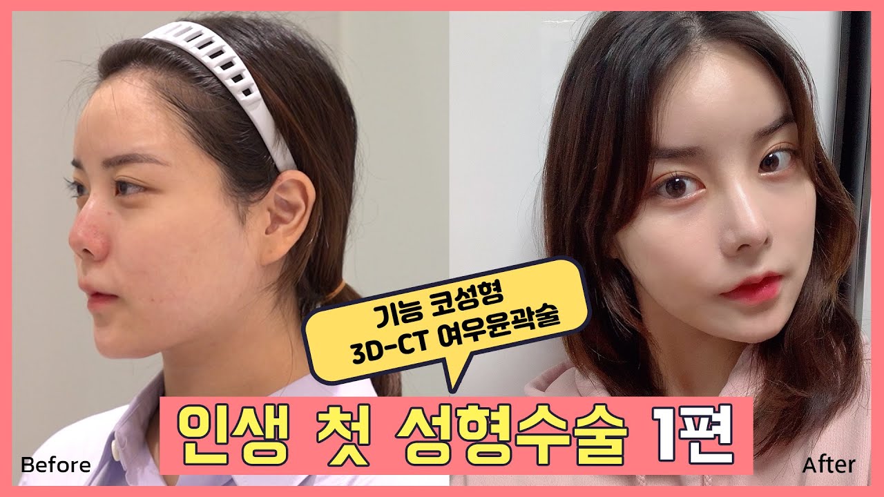 [Phẫu thuật thẩm mỹ ATOP] Vừa có gương mặt đẹp vừa giải quyết được viêm mũi! ★Chỉ tập hợp những thông tin cần thiết phải kiểm tra trước khi phẫu thuật [Xét nghiệm máu, chụp CT 3D, nội soi, phẫu thuật mũi chức năng] /Phẫu thuật thẩm mỹ ATOP/ATOP plastic surgery