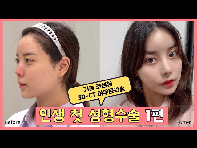 예쁜 얼굴에 비염 해결까지! ★수술 전 꼭 확인해아 할 필수정보만 모아보기[피검사, 3D-CT촬영, 내시경 검사, 기능코성형] /에이탑성형외과/ATOP plastic surgery