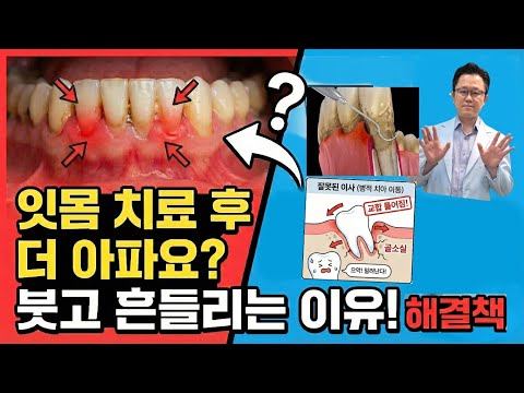 What are the causes and treatments for gum swelling and shaking after gum treatment?