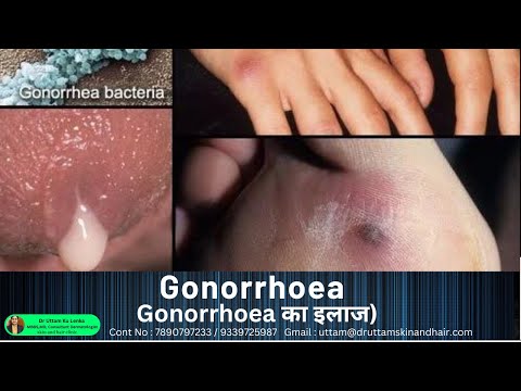 Gonorrhoea / penis pus discharge/ penile infection |गॉनरीअ / लिंग से पीप निकलना  / Dr Uttam Lenka
