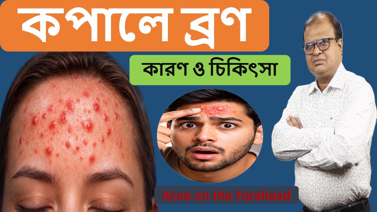 কপালে ব্রণ |  Acne on the Forehead | হোমিওপ্যাথিক চিকিৎসা