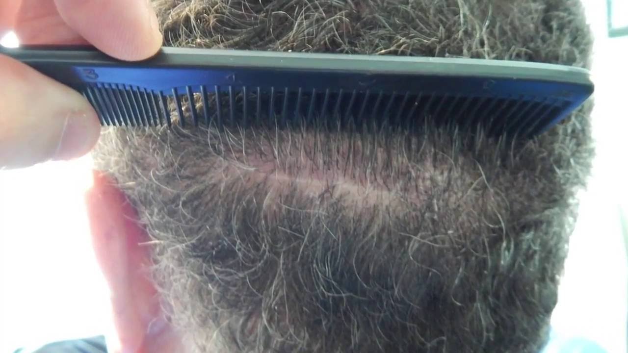 Hair Clinic Near Manchester, MD 21102 YouTube