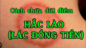 BỆNH HẮC LÀO(LÁC ĐỒNG TIỀN)_ nguyên nhân; cách chữa & phòng ngừa tái phát. |Dược Sĩ Ngọc Bé|
