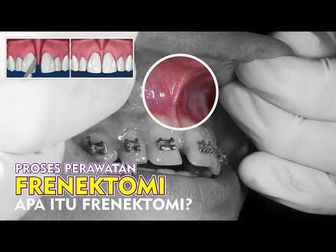 Video: Prosedur Frenektomi, Pemulihan, Dan Gambar Sebelum Dan Setelah