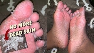 Peeling ALL the DEAD SKIN Off my Feet! Intense Foot Peel for Baby Smooth  feet! - YouTube