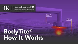 BodyTite Skin Tightening and Body Contouring How It Works | Offered by Dr. Hooman Khorasani