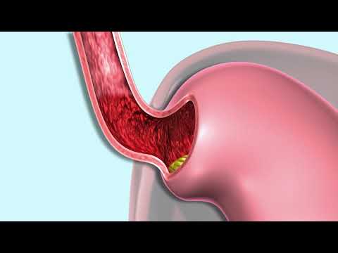 Gastroesophageal Reflux (GERD)