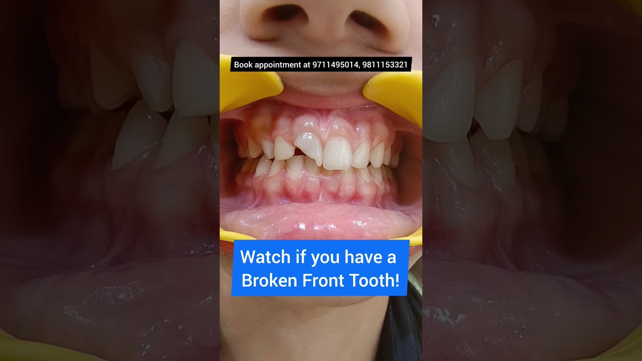 broken teeth repair｜TikTok Search