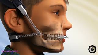 Class II Headgear, Combination Pull | Dental Braces | Temecula Valley, CA