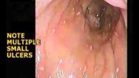 MULTIPLE AMEBIC ULCERS IN THE COLON