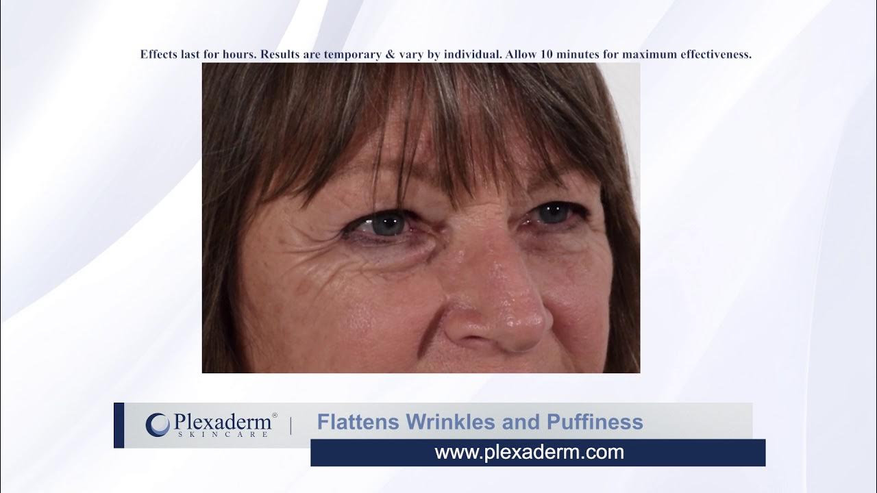 Plexaderm Lives Up to Its Promise Plexaderm Lives Up to Its Promise