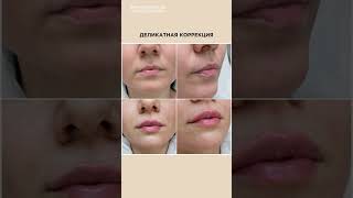 Увеличение губ деликатным филлером #коррекциягуб