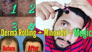 Derma Rolling For Hair Regrowth | Minoxidil | How To Use Derma Rolling System | Classy Indian