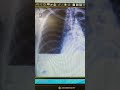 #hydrothorax #TB #chest #intercostal chest drain #icd #doctor #treatment