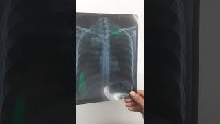 🫁 Tuberculosis (TB) Chest X-ray Explained | TB में X-ray कैसे बदलता है | Doctor Explains