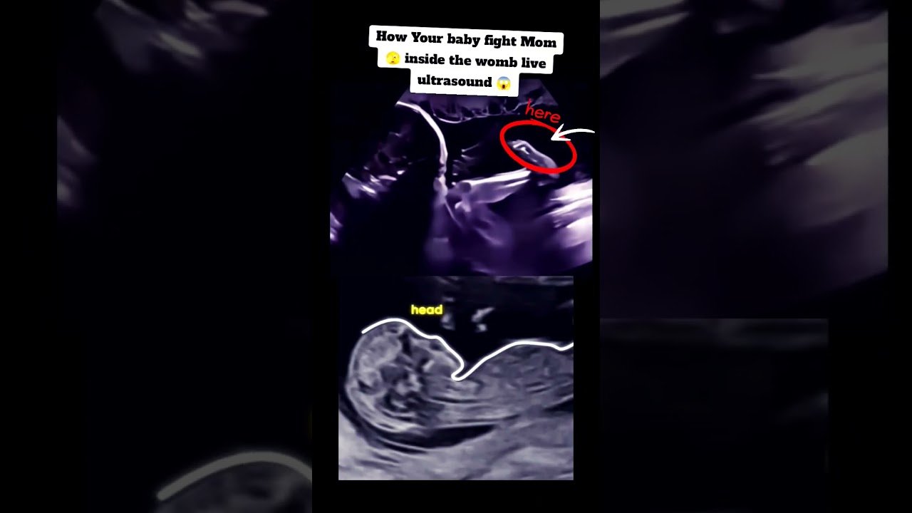 How your baby fight inside womb live ultrasound|