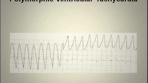 ECG Interpretation Video Lecture Module 5-A of 6