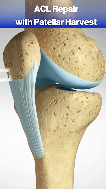 What happens when you tear your ACL? #acl #knee #kneepain