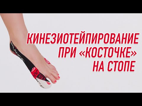 ▶️ КИНЕЗИОТЕЙПИРОВАНИЕ ПРИ "КОСТОЧКЕ" НА СТОПЕ