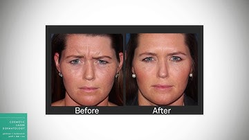 What to Expect From Botox Injections