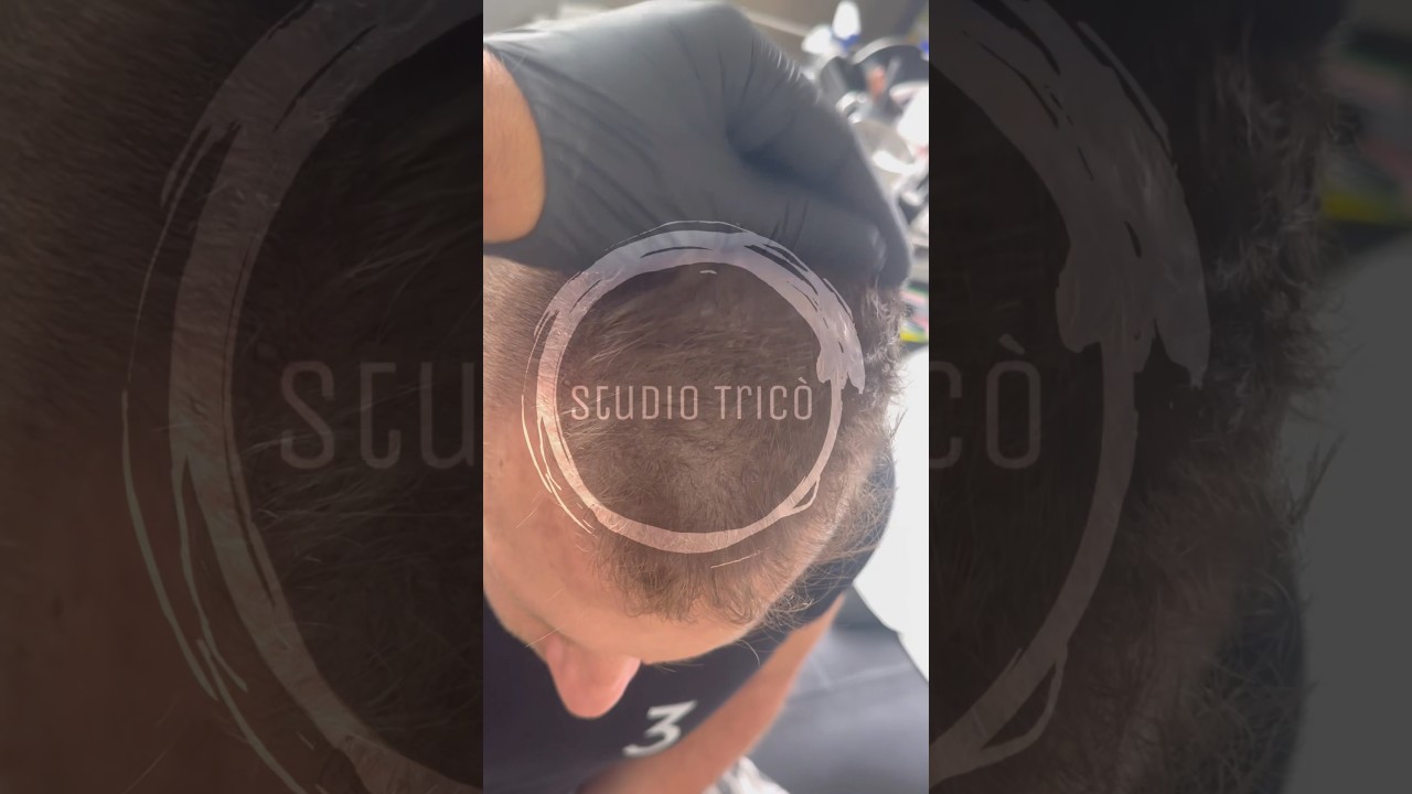 Tricopigmentazione Effetto Infoltimento: Risultato TOP su Capelli Lunghi e Diradati | Prima e Dopo