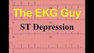 EKG/ECG ST-segment Depression - Question 15.0 | The EKG Guy